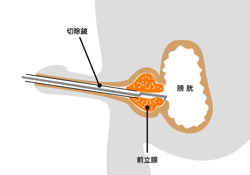 TUR-P（経尿道的前立腺切除術）画像